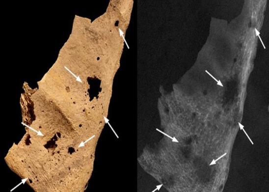 3,200-Year-Old Skeleton is Oldest Known Case of Human Cancer