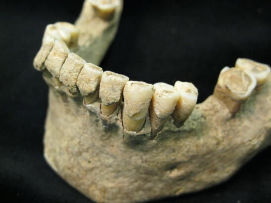 New Research Drills Into History of Cavities