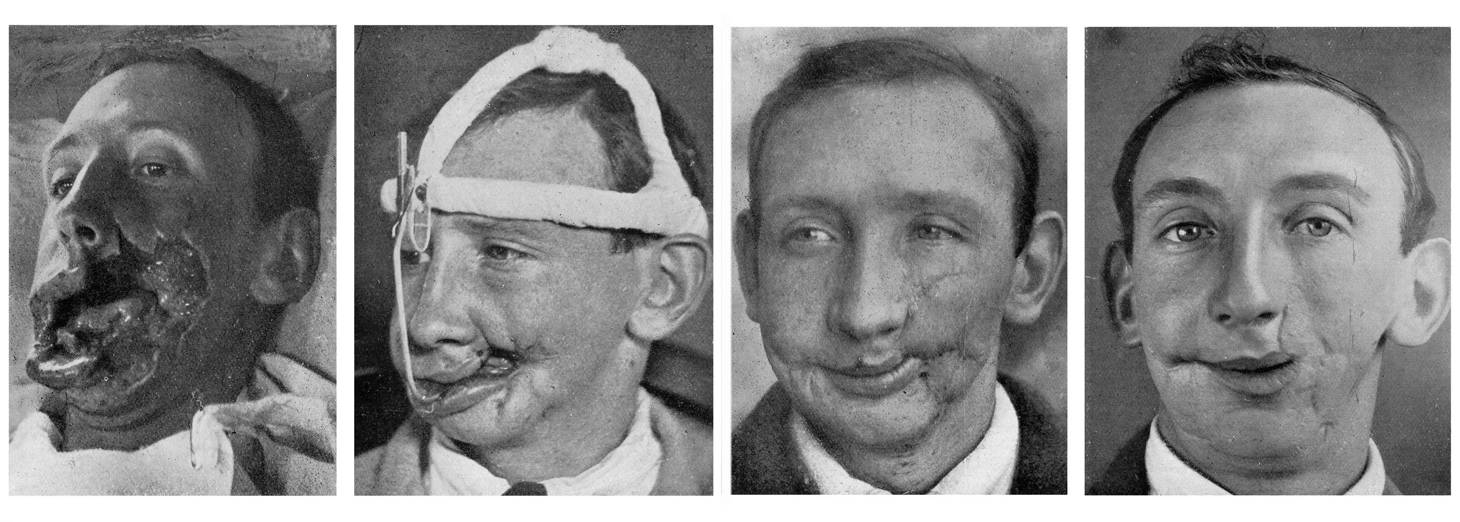 World War I Veterans Ravaged Faces Red By Innovative Plastic Surgery. 