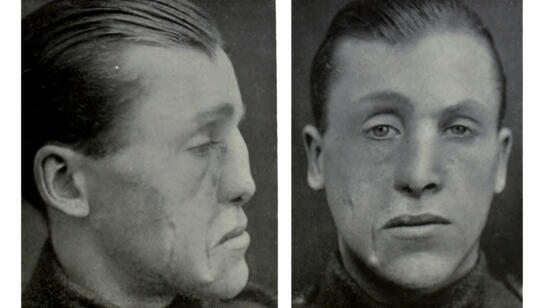 Innovative Cosmetic Surgery Restored WWI Vets' Ravaged Faces—And Lives