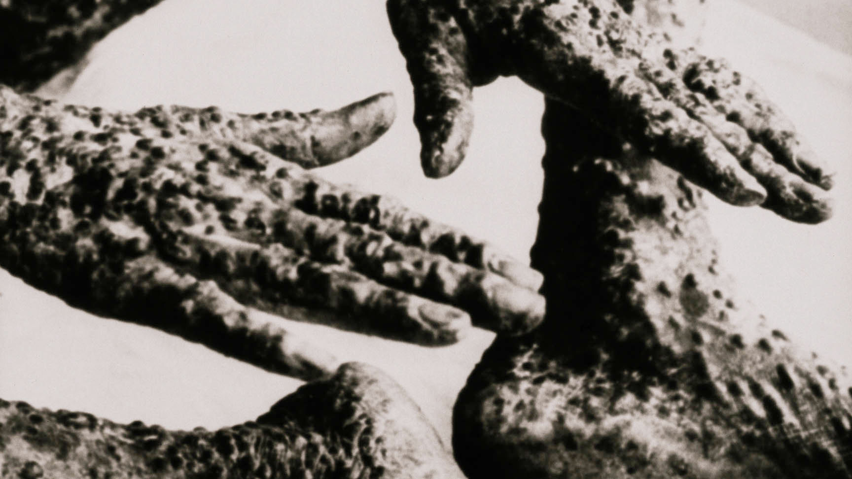 a closeup of the hands of a man with smallpox