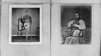  The Civil War Doctor Who Proved Phantom Limb Pain Was Real