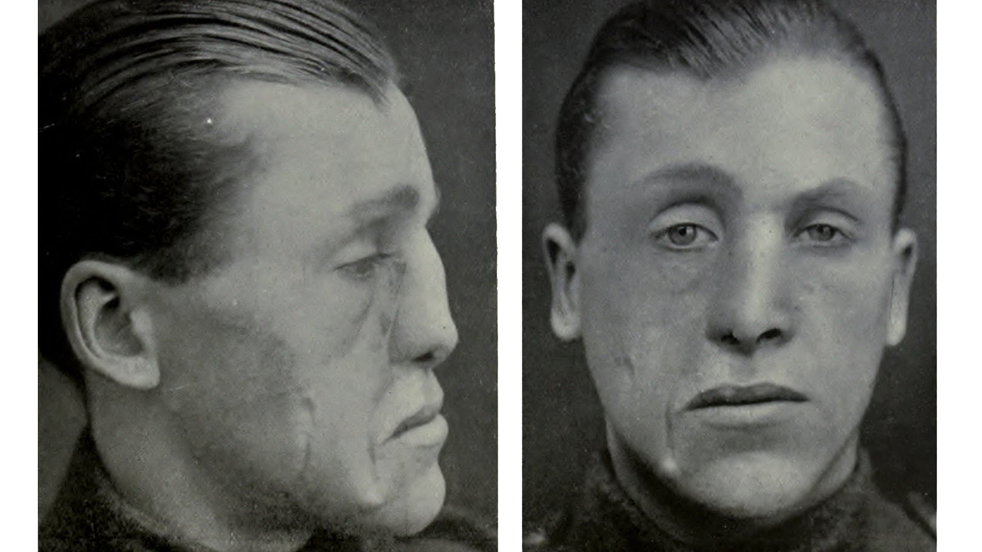 Innovative Cosmetic Surgery Restored WWI Vets’ Ravaged Faces—And Lives