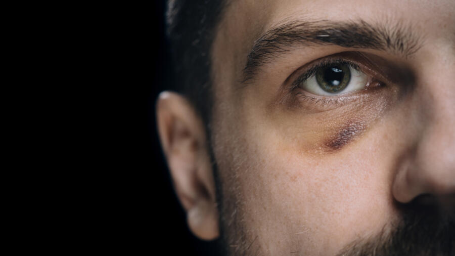 Conceptual photo of an abused man with a black eye