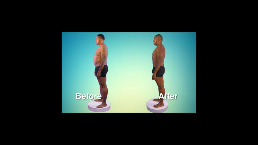 Atlanta Plastic Season 1 Before & After