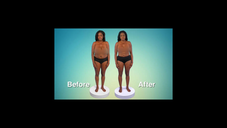 Atlanta Plastic Season 1 Before & After