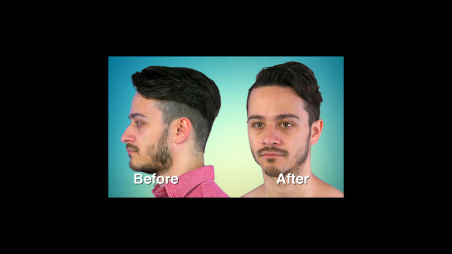 Atlanta Plastic Season 1 Before & After