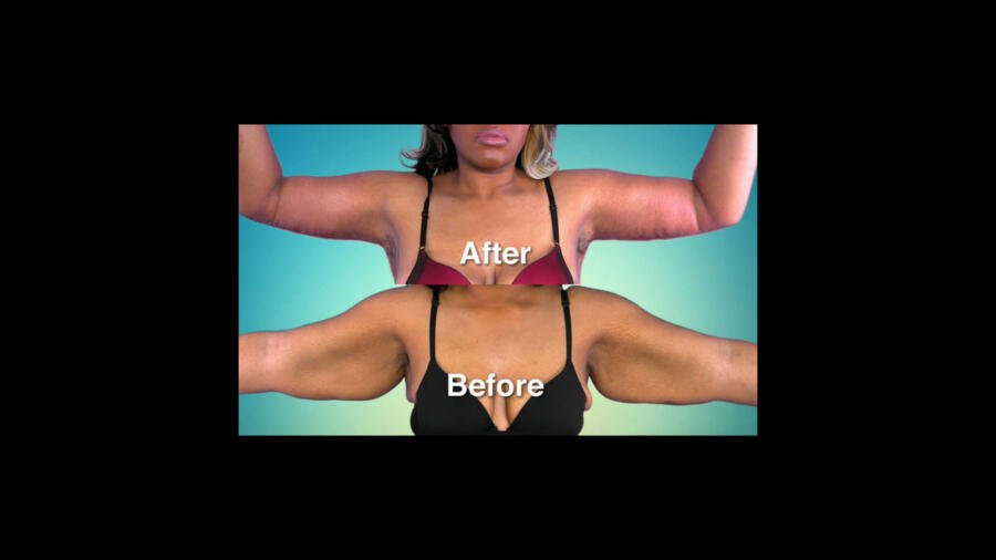 Atlanta Plastic Season 1 Before & After