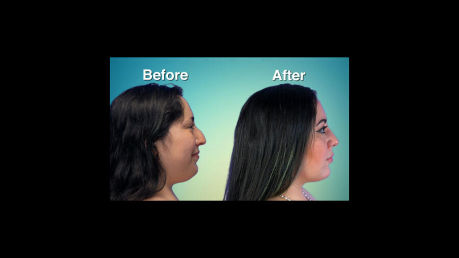 Atlanta Plastic Season 1 Before & After