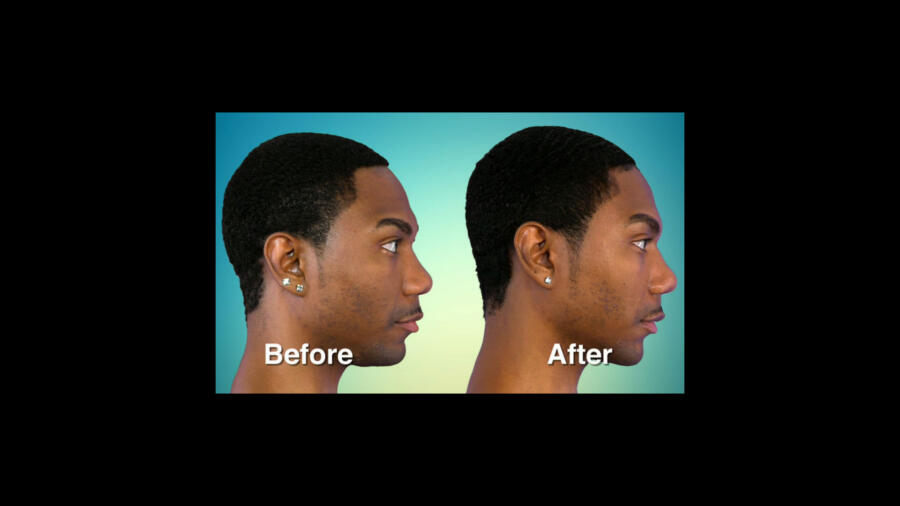 Atlanta Plastic Season 1 Before & After