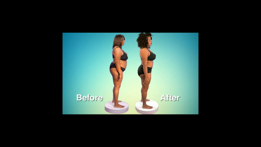 Atlanta Plastic Season 1 Before & After