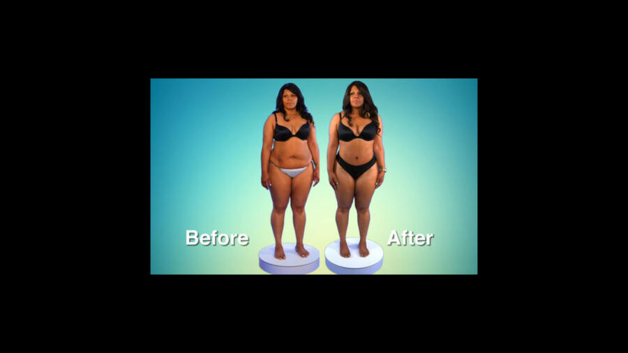 Atlanta Plastic Season 1 Before & After