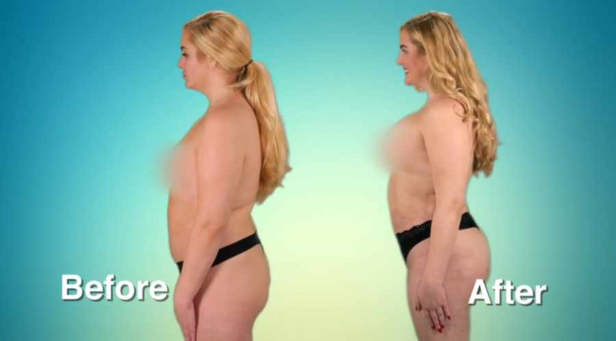 Atlanta Plastic Season 2 Before and After