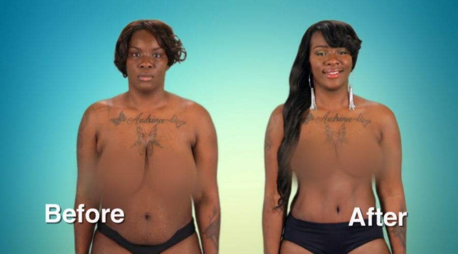 Atlanta Plastic Season 2 Before and After