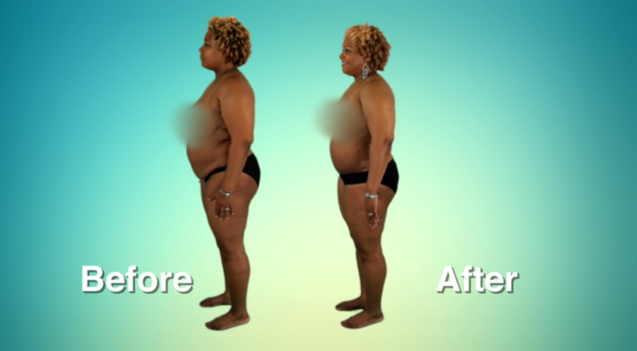 Atlanta Plastic Season 2 Before and After