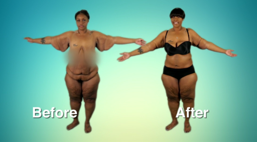 Atlanta Plastic Season 2 Before and After