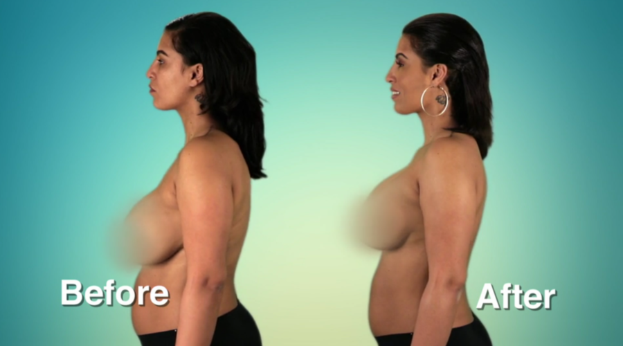 Atlanta Plastic Season 2 Before and After