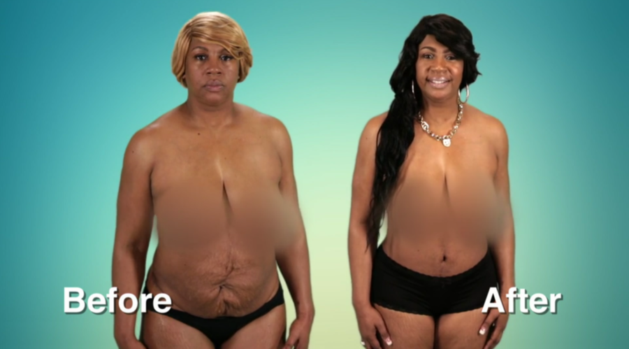 Atlanta Plastic Season 2 Before and After