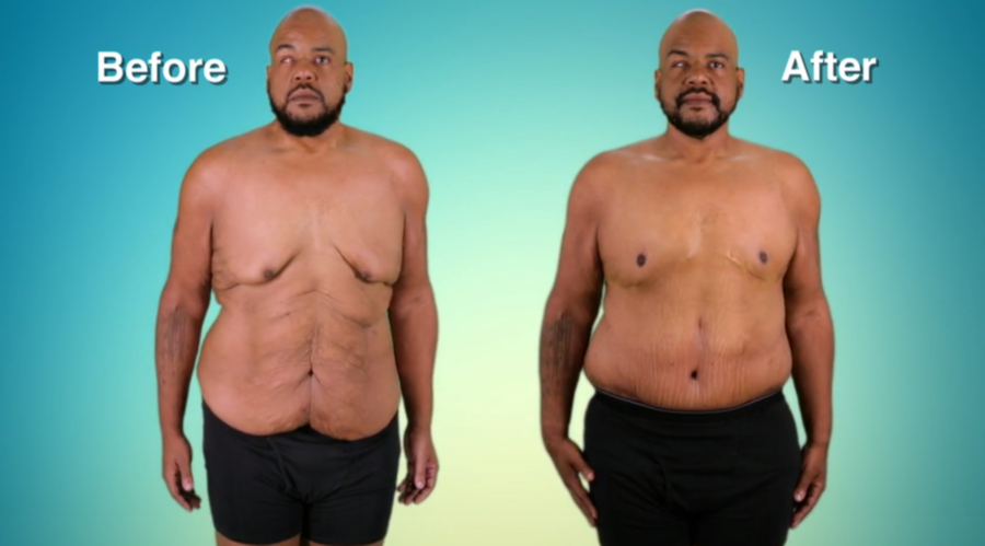 Atlanta Plastic Season 2 Before and After